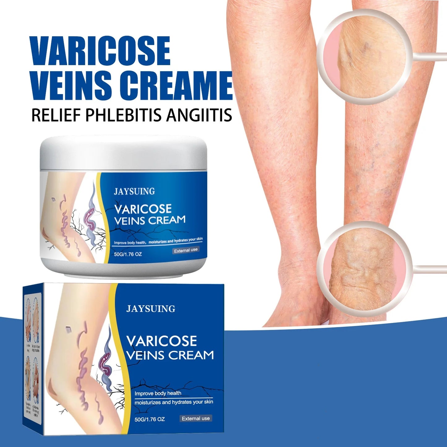 Jaysuing Veins Treatment Cream For Vasculitis And Phlebitis Relief