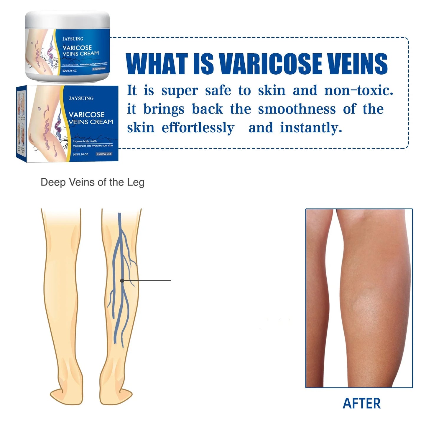 Jaysuing Veins Treatment Cream For Vasculitis And Phlebitis Relief